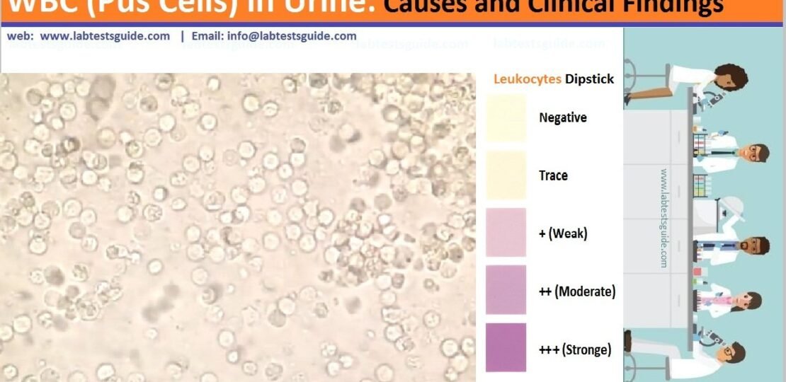 WBC in Urine